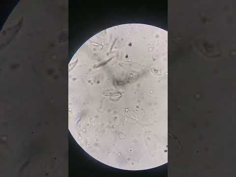 Urine sample: WBC above normal #laboratory #mls #cls #medtechstudent #microscope #medtech #urine